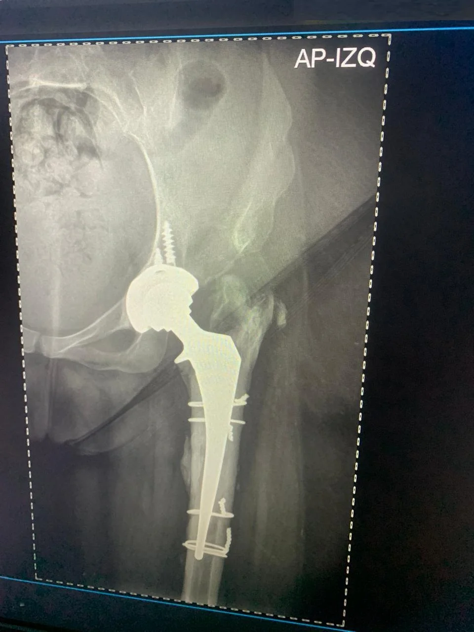 Radiografía postoperatoria de reemplazo total de cadera derecha exitoso - Dra. Ana Luz Bernabe