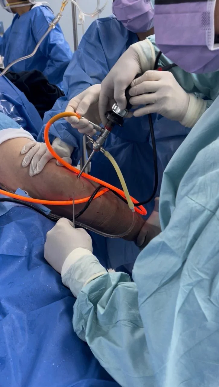 Resonancia magnética mostrando ruptura de ligamento cruzado anterior (LCA) en rodilla